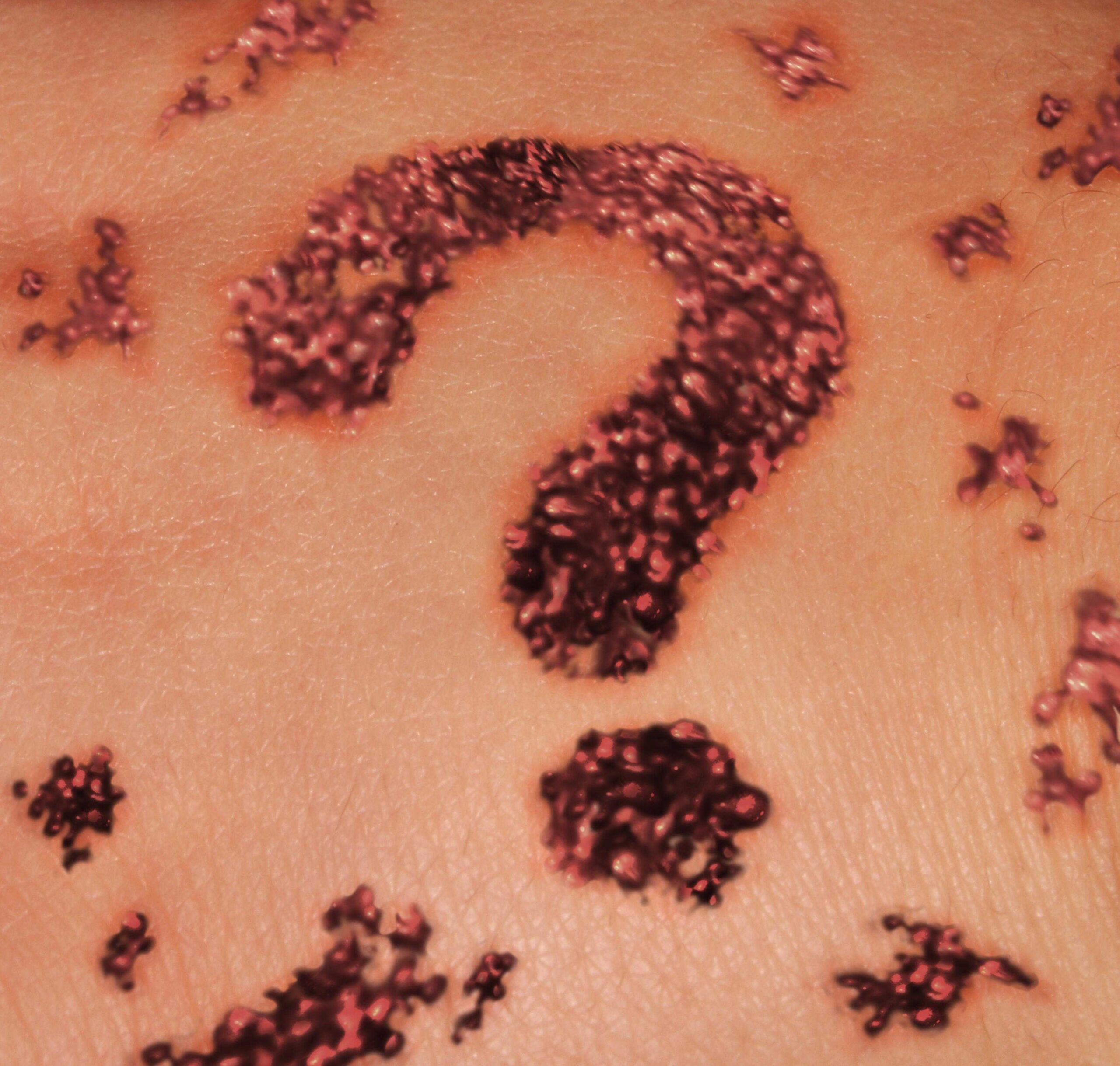 Are You at Risk for Melanoma