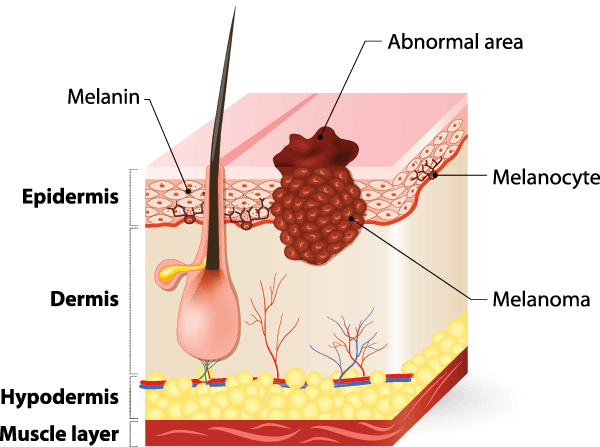 What is Melanoma